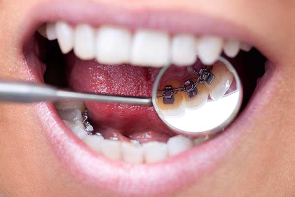 Lingual Braces Closeup with dental mirror