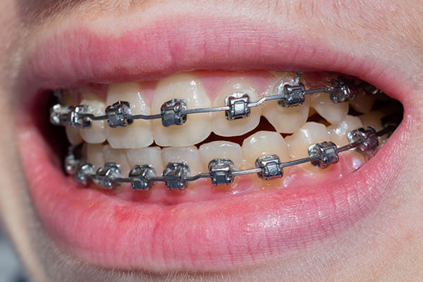 Metal Orthodontic Brackets to correct crossbite