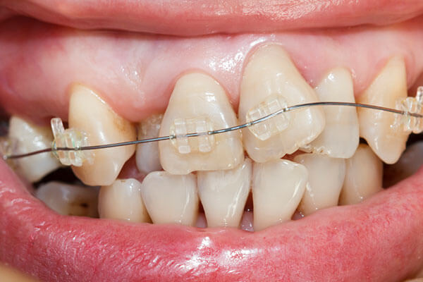 Clear Orthodontic Brackets to correct crowded teeth