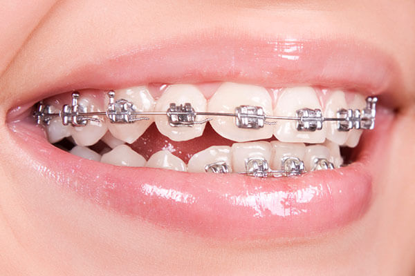 Metal Orthodontic Brackets to correct open bite problem