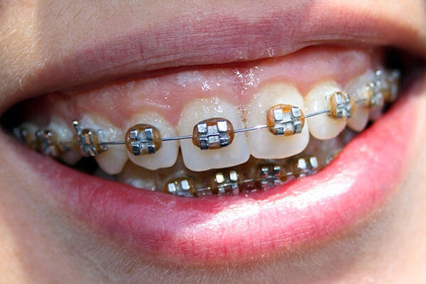 Metal orthodontic brackets to correct overbite