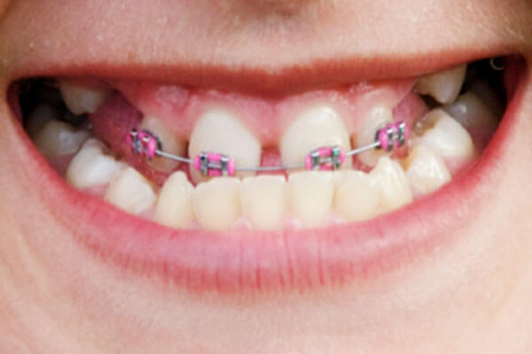 Metal Orthodontic Brackets to Correct Underbite